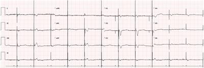 Management of PFO in paradoxical embolic stroke with hemorrhagic conversion: a case report